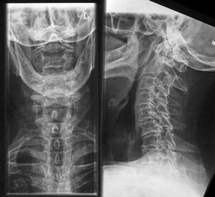 A nyaki gerinc röntgenfelvétele - módszer az osteochondrosis diagnosztizálására