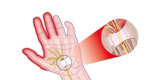fájdalom az ujjak ízületeiben rhizarthrosissal