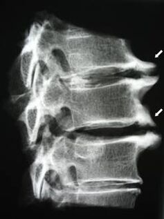 A nyaki gerinc osteophytái nyaki fájdalmat okoznak