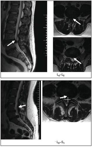 A gerinc herniált lemezének MRI vizsgálata
