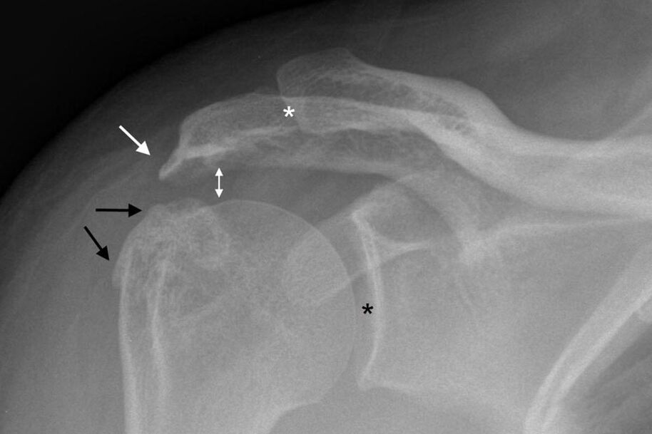 a vállízület arthrosisa röntgenfelvételen